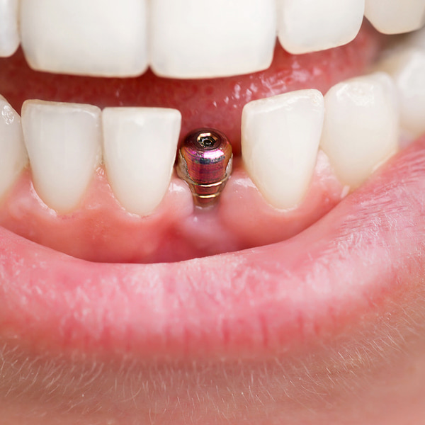 implante-dental.jpg